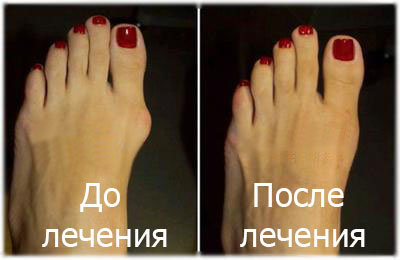 Лечение вальгусной деформации первого пальца стопы (шишка на ноге)!