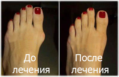 Бальгусная диформация первого пальца стопы