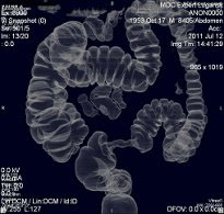 колоноскопия в днепре